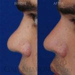 Radiesse For Nose Reshaping Photos (1)