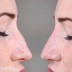 Radiesse For Nose Reshaping Photos (3)