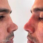 Radiesse For The Male Nose