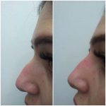 Radiesse For Twisted, Crooked Or Asymmetrical Nose
