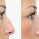 Radiesse Is A Recontouring With Non-surgical Nose Job Procedure
