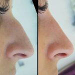 Radiesse Non Surgical Rhinoplasty Before And After Photos (1)