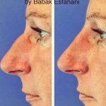 Radiesse Non Surgical Rhinoplasty Before And After Photos (2)
