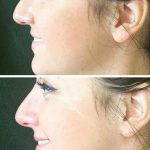 Radiesse Non Surgical Rhinoplasty Before And After Photos (3)