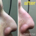 Radiesse Nose Before And After (2)