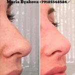 Radiesse Nose Before And After (3)