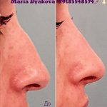 Radiesse Nose Before And After (4)