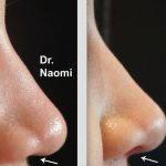 Radiesse Nose Before And After (6)