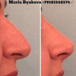 Radiesse Nose Before And After (8)