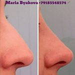 Radiesse Nose Before And After (9)