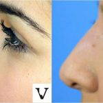 Radiesse Nose Correction Before And After