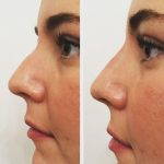 Radiesse Nose Job Before After
