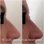 Radiesse Nose Job Can't Make Your Nose Smaller Or Improve Conditions Inside Your Nose