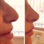 Radiesse Nose Job Is Used To Correct A Wide Range Of Defects In The Nose