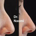 Radiesse Nose Lift Picture (1)