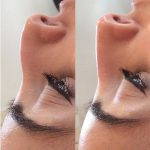Radiesse Nose Lift Picture (2)