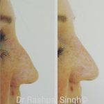 Radiesse Nose Reshaping Photo (1)