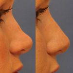 Radiesse Nose Reshaping Photo (2)