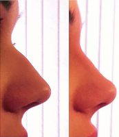Radiesse Rhinoplasty Cannot Make A Larger Nose Appear Smaller Or Improve Breathing