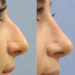 Removing A Hump From The Bridge Is One Of The Most Common Things During Hooked Nose Rhinoplasty