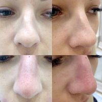 Reshaping A Large Nose Before And After Photos