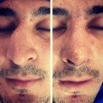Rhinoplasty Before After Big Nose (1)