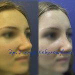 Rhinoplasty Before After Big Nose (2)