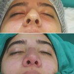 Rhinoplasty Before After Big Nose (3)