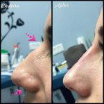 Rhinoplasty Big Nose Before After (12)
