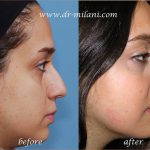 Rhinoplasty Big Nose Before After (13)
