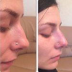 Rhinoplasty Big Nose Before After (2)