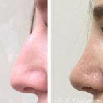 Rhinoplasty Big Nose Before After (3)