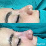 Rhinoplasty Big Nose Before After (4)