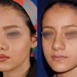 Rhinoplasty Big Nose Before After (6)