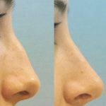 Rhinoplasty Big Nose If The Nose Is To Far Away Away From The Face