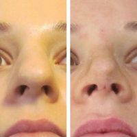 Rhinoplasty Big Nose Is The Most Challenging Operative Procedure Done In Cosmetic Plastic Surgery For Nose