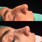 Rhinoplasty Big Nose To Small Nose Preop An Postop (13)