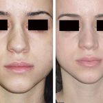 Rhinoplasty Big Nose To Small Nose Preop An Postop (14)