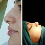 Rhinoplasty Big Nose To Small Nose Preop An Postop (15)