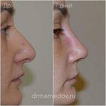Rhinoplasty Big Nose To Small Nose Preop An Postop (5)