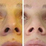 Rhinoplasty Big Nose To Small Nose Preop An Postop (8)