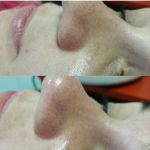 Rhinoplasty Big Nose To Small Nose Preop An Postop (9)