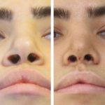 Rhinoplasty For Big Nose If You're Unhappy With Your Nose