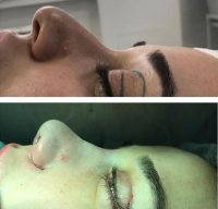 Rhinoplasty For Big Nose Is A Very Unique Operation In That Changes In Nasal Shape Continue To Occur Over The Patient's Lifetime