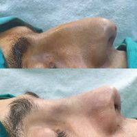 Rhinoplasty For Man Means Changes In Micro Millimeters