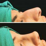 Rhinoplasty Hooked Nose Is Among The Five Most Popular Plastic Surgery Procedures Performed In The United States