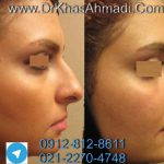 Rhinoplasty Hooked Nose With A Relatively Straight Forward Hump Reduction
