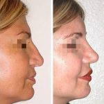 Septoplasty Before And After Photos (1)