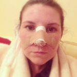 Septoplasty Before And After Photos (11)