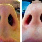Septoplasty Before And After Photos (2)